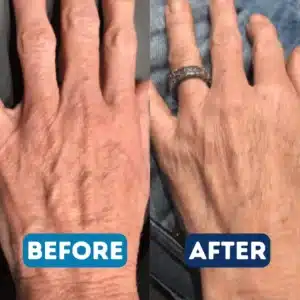 cool-peel-tetra-before-and-after-a-in-serenity-medspa-pooler-ga