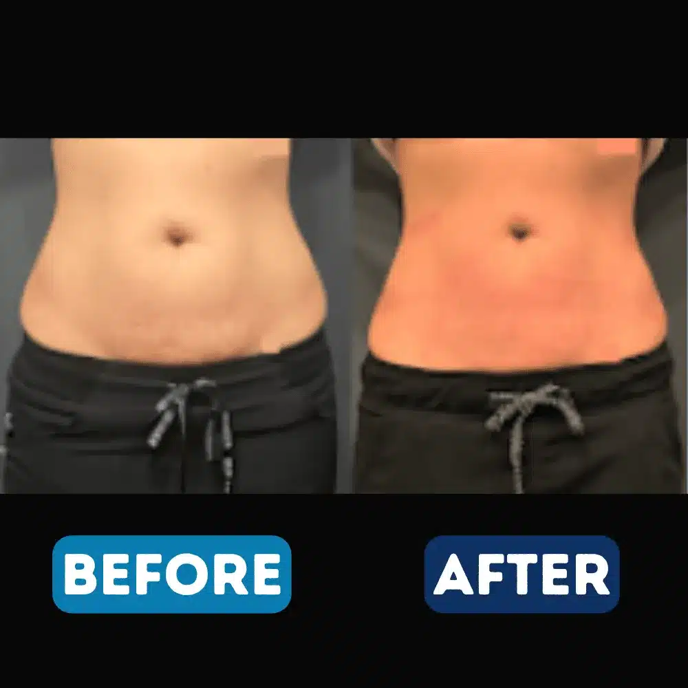 body-contouring-before-after-a-in-serenity-med-spa-pooler-ga