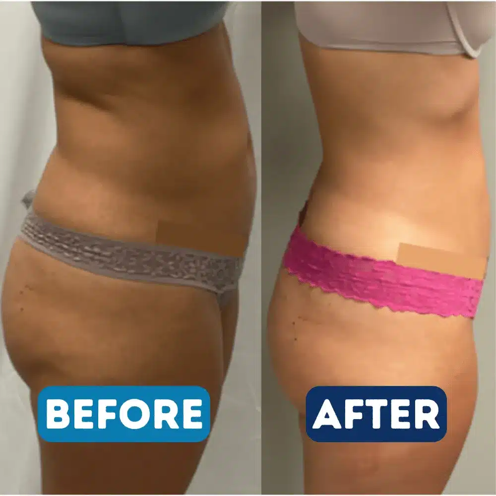 body-contouring-before-and-after-b-in-serenity-medspa-pooler-ga